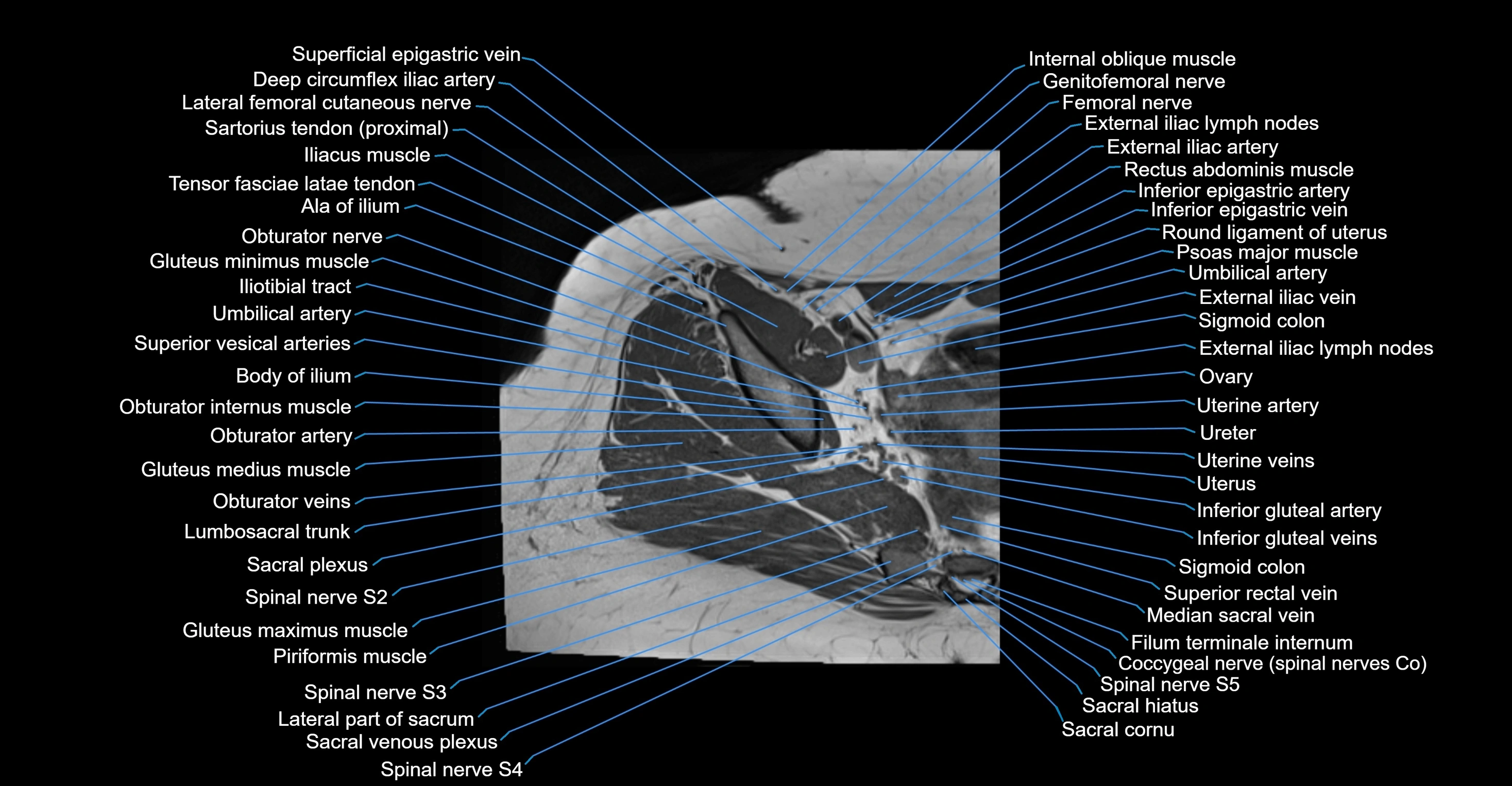 MRI hip axial cross sectional anatomy 3T 3D  radiology  anatomy image-img-00001-00014.webp